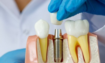 Dental Implant Surgery | Hawthorn East Dental