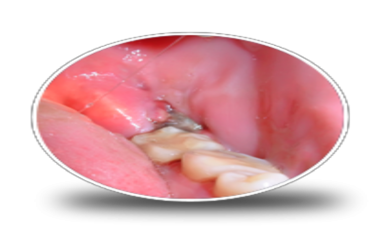Wisdom Tooth Infection | Wisdom Teeth Dentist