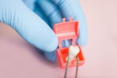 Wisdom Tooth Extraction | Western Dental