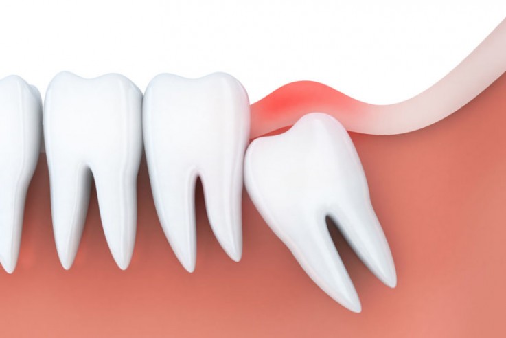 Wisdom Tooth Extraction | Western Dental