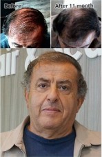 Natural and Herbal Hair Treatment in Brisbane