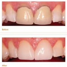 Most Effective Dental Veneers for Your Teeth