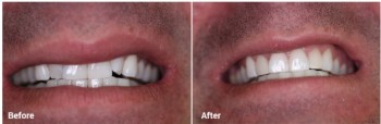 Porcelain Veneers Melbourne | Prahran Family Dental