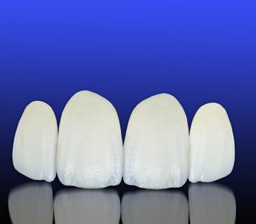 Porcelain Veneers Melbourne | Prahran Family Dental