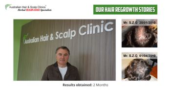 Result Oriented Hair Loss Treatment in Perth