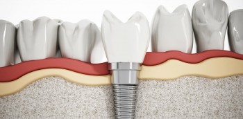 Implant dentistry Treatment | Prahran Family Dental