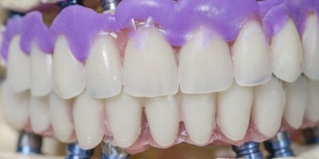 Implant dentistry Treatment | Prahran Family Dental