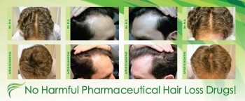 Looking for Hair Loss Treatment in Adelaide?