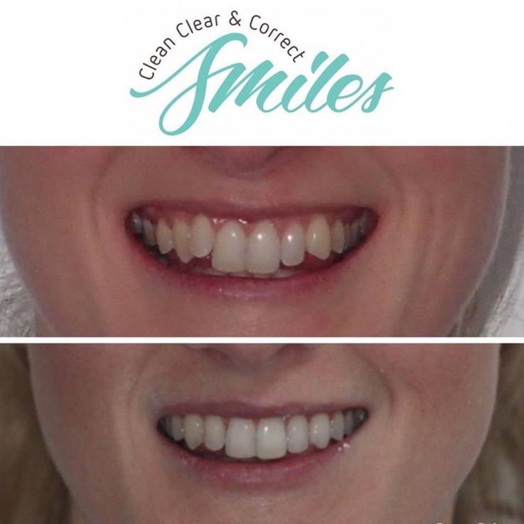 A Beautiful New Smile at an Affordable Price