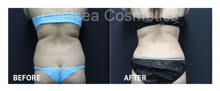Get Rid Of Your Stubborn Fats. Get This Liposuction Surgery in Melbourne From Chelsea Cosmetics!