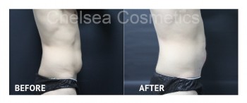 Effective Coolsculpting in Melbourne $850 Per Cycle - Contact Chelsea Cosmetics!