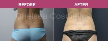 Effective Coolsculpting in Melbourne $850 Per Cycle - Contact Chelsea Cosmetics!
