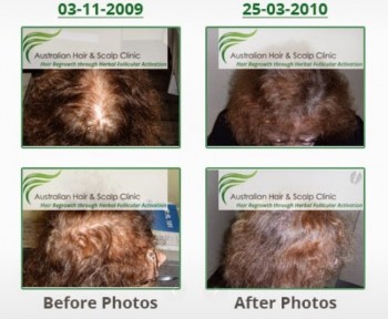 Get Back Your Confidence with Our Hair Treatment in Sydney