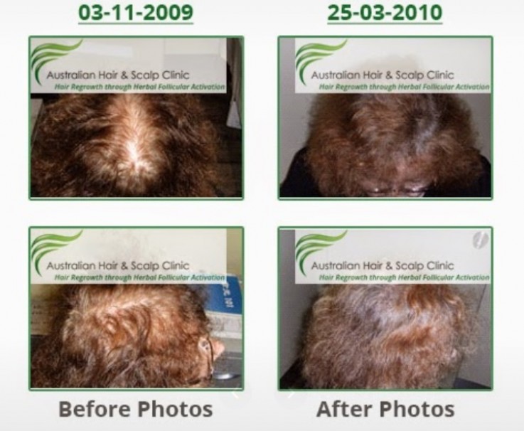 Get Back Your Confidence with Our Hair Treatment in Sydney