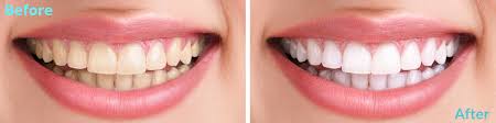 Teeth Whitening Baulkham Hills