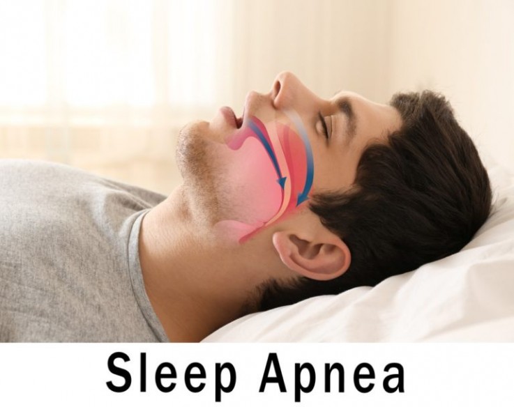 Specialist in Snoring Treatment in Melbourne from Chelsea Cosmetics Melbourne - Call Us Today!