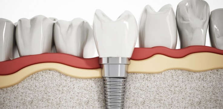 Best Dental implants Melbourne | Prahran Family Dental