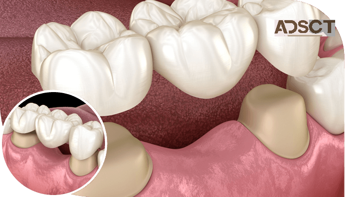 Durable and Natural-Looking Dental Crowns and Bridges