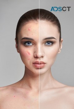 Ultherapy in Queensland - Skin Tightening Cost