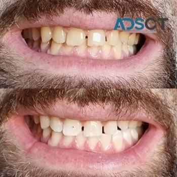 Teeth whitening Melbourne