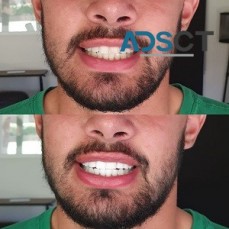 Teeth Whitening Dentist in Melbourne