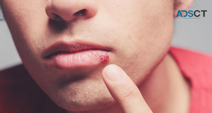 Skin Care Experts's Advice for the Treatment of Cold Sores