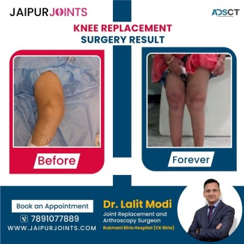 Get effective Knee Replacement surgery in Jaipur by Dr. Lalit Modi
