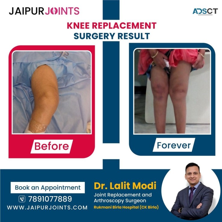 Get effective Knee Replacement surgery in Jaipur by Dr. Lalit Modi