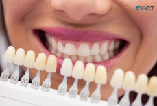 Transform Your Smile with Dental Veneers in Brisbane 