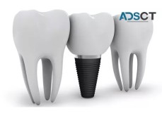 Competitive Dental Implants Cost Melbourne