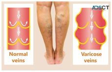 Improve Your Life Easily with Varicose Veins Treatment in Ayurveda