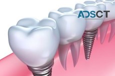 Top-Notch Dental Implants Sydney - No Gap Dentists