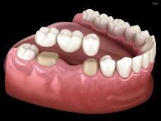 Reclaim Your Smile with Dental Crowns & Bridges!
