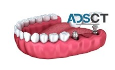Get Latest Information on Dental Implants - Dental Costs Australia