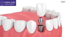 Dental implants cost