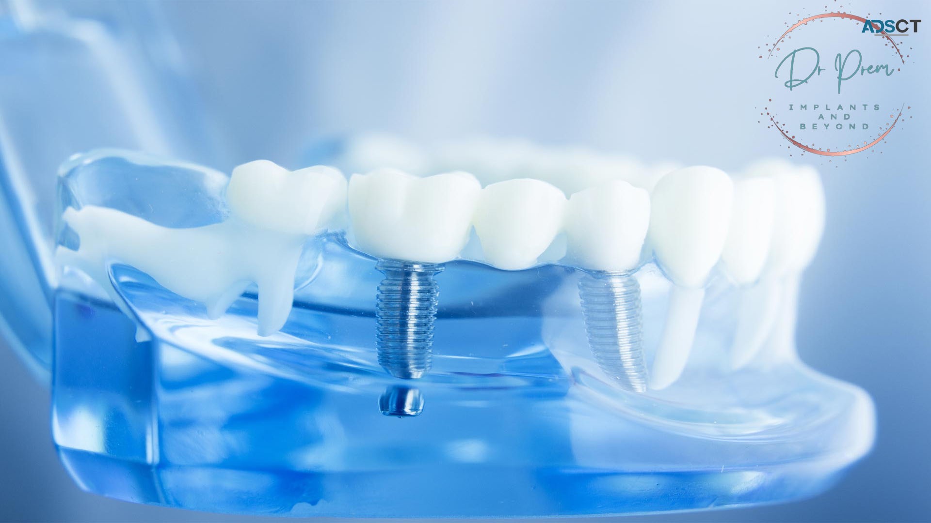 All on 4 dental implants cost in india