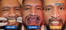A Smile Reborn: Dental Implants Before and After