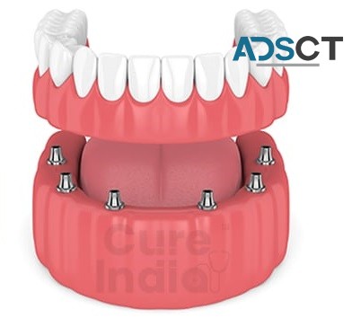 Do you want to know about the cheapest country for dental implants?