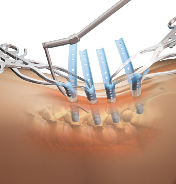 Safe And Effective Minimally Invasive Spine Surgery: Call Today